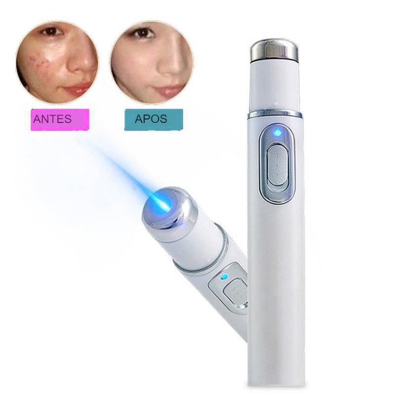 Caneta Laser Anti Acne e Varizes - Elimine as varizes e a acne de forma eficiente!