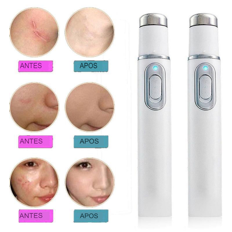 Caneta Laser Anti Acne e Varizes - Elimine as varizes e a acne de forma eficiente!